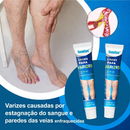 Varicream 3 em 1 - VARIZES, VASINHOS E INCHAÇOS!